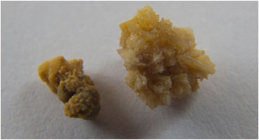 kidney stones chattanooga