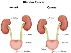 Bladder Cancer Treatment in Chattanooga, TN