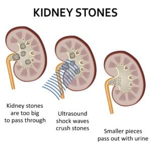 kidney stone treatment