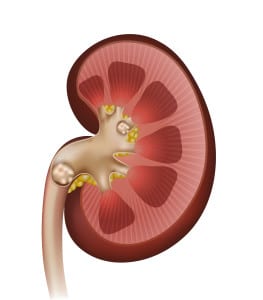 kidney stones chattanooga tn