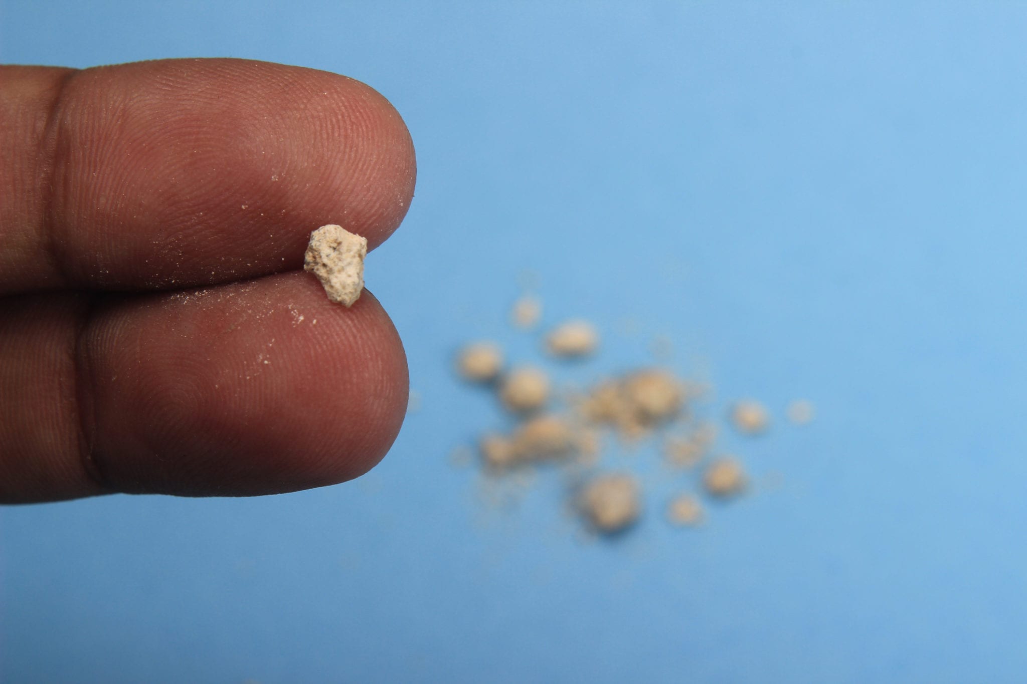 Kidney Stones Chattanooga UT Erlanger Urology