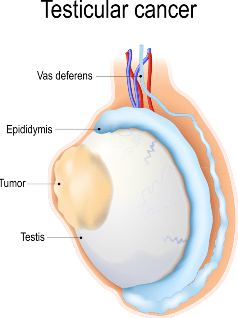 Testicular Cancer