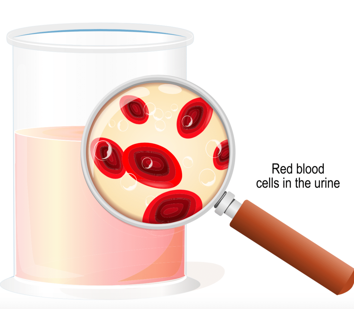 Blood In Urine | Chattanooga, TN | UT Urology - UT Erlanger Urology
